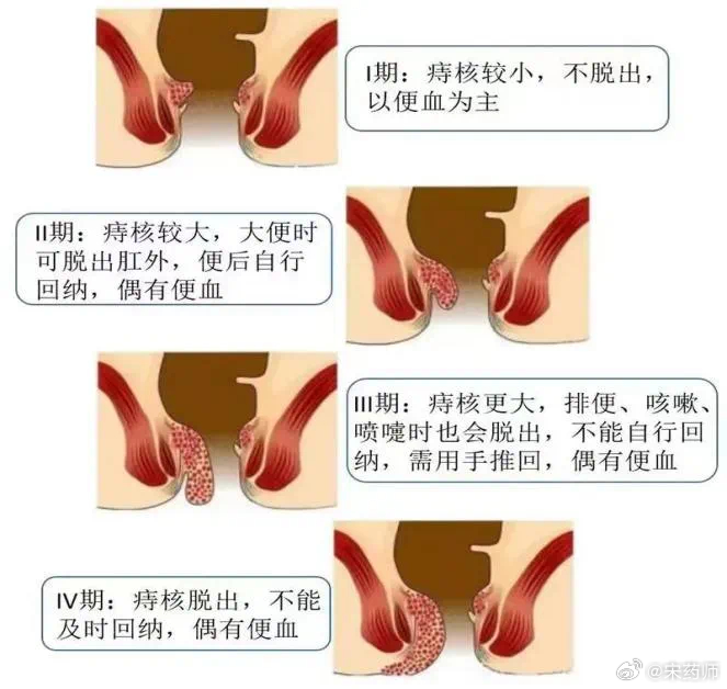 痔疮全面指南，在线了解、预防与治疗策略